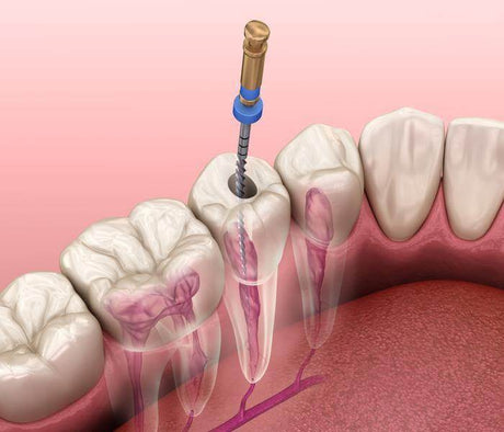 Endodontic