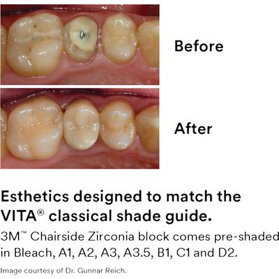 3M™ Chairside Zirconia Introductory Kit for CEREC® Blocks